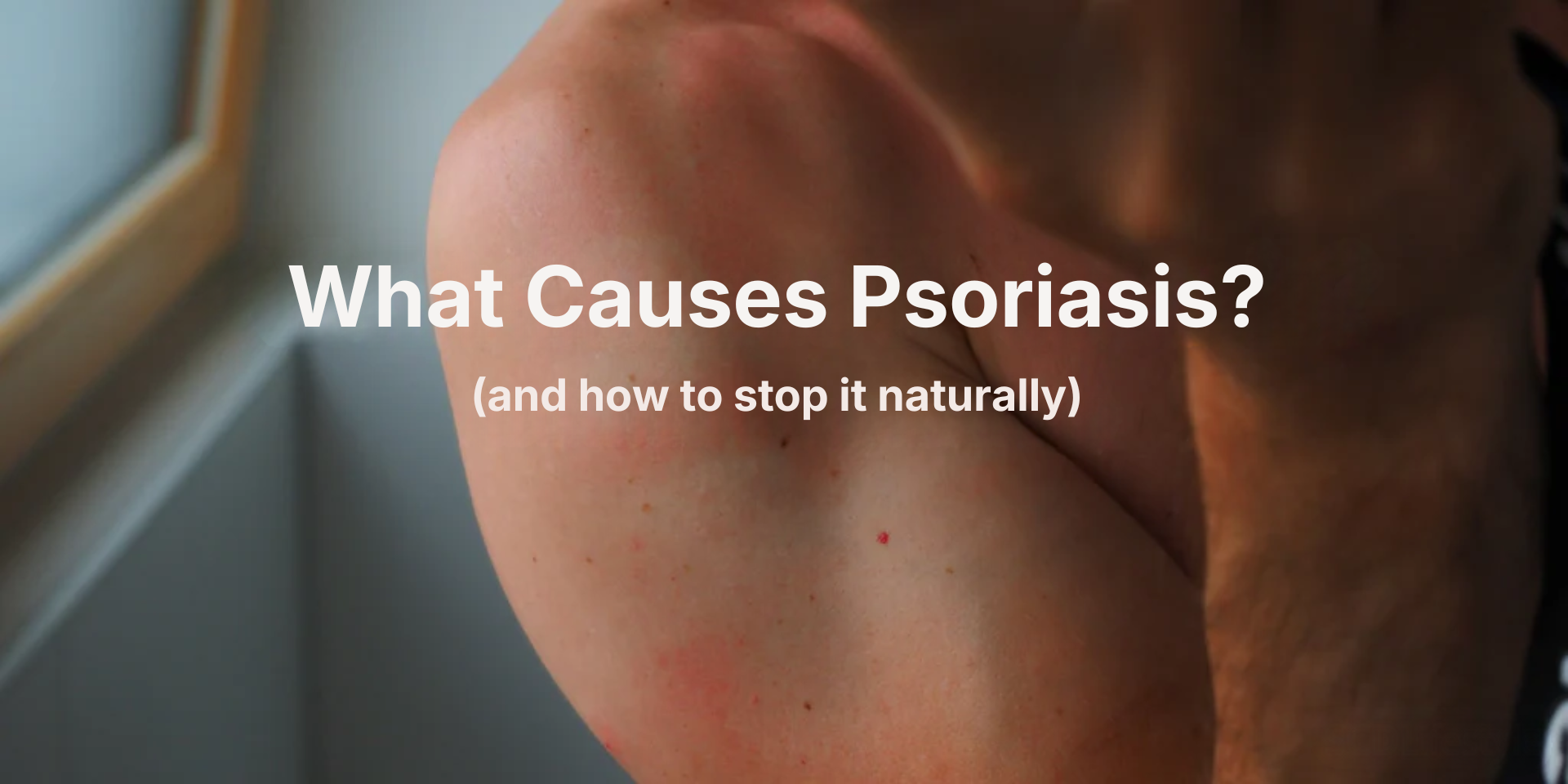 Close-up of upper arm with red psoriasis patches; overlaid text: 'What Causes Psoriasis?' '(and how to stop it naturally)'